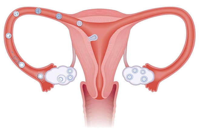 5 razones infertilidad. Trompas falopio