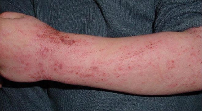 Pruebas para diagnosticar la alergia en la piel