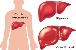 Hepatitis autoinme. Inflamación hígado